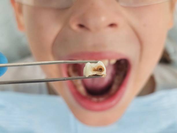 Best Emergency Dentist for Knocked-Out Tooth in Perry, LA